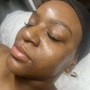 Acne Facial