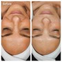 Express facial