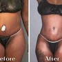 BODY CONTOURING 5 SESSIONS