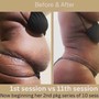 BODY CONTOURING 5 SESSIONS