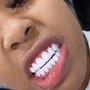 Teeth Whitening