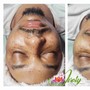 Chemical Peel Treatment