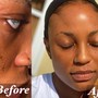 Eyebrow: Microblading