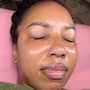 Acne Facial