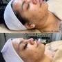 Acne Facial w/ LED