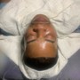 Microdermabrasion