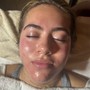 Acne Facial