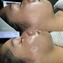 Epicutis + HydraFacial Neck + Décolleté