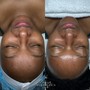 Glo2Facial-Better Skin