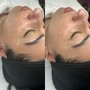 AcneClear Facial