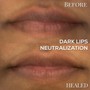 Dark Lips Neutralization