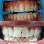 Advance teeth whitening