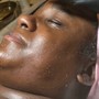 Microdermabrasion