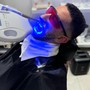 Teeth Whitening