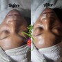 Chemical Peel Treatment