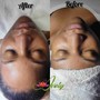 Chemical Peel Treatment