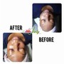 Chemical Peel Treatment