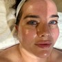 Acne Facial