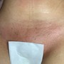 Ingrown hair/pimple removal