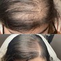 Keravive Scalp Exfoliating Treatment for Thinning Hair