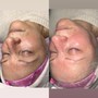 Hydra Facial