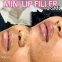 1 syringe lip filler