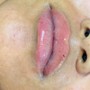 1 syringe lip filler