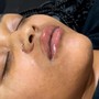 MicroNeedling