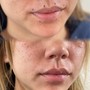 MicroNeedling