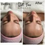 Back Facial