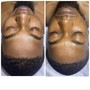 Microdermabrasion