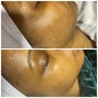 Microdermabrasion