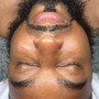 Microdermabrasion