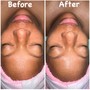 Microdermabrasion Facial