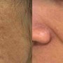 Microneedling skin rejuvenation