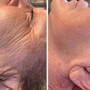 Microneedling skin rejuvenation