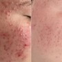 Epicutis + HydraFacial Neck + Décolleté