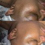 Acne Facial