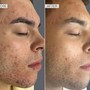 Chemical peel