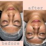 Oxygen Facial