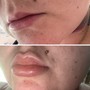 1 syringe lip filler