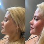 Double chin Laser Lipo (non surgical)