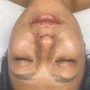 Microdermabrasion