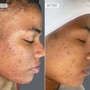 Acne Facial