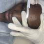 MicroNeedling