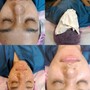 Chemical Peel Facial Treatment