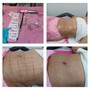 Non Invasive Ultrasonic Cavitation