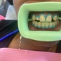 Teeth Whitening