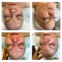 Chemical Peel Facial Treatment