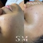 Microdermabrasion